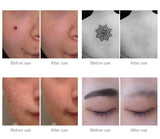 Scar and Acne Remover Treatment Laser Pen