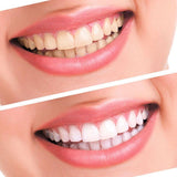 Advanced Teeth Whitening Kit for Professional LED Dental Treatment